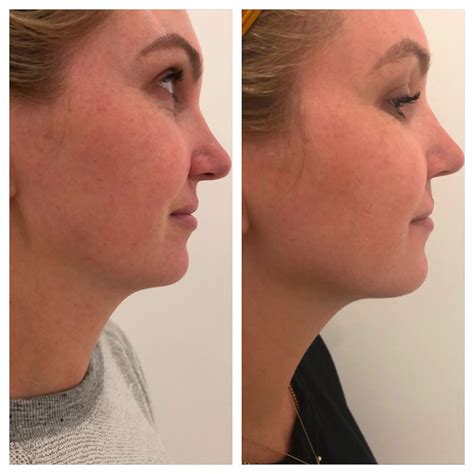 Kybella Before And After Somewhere Lately