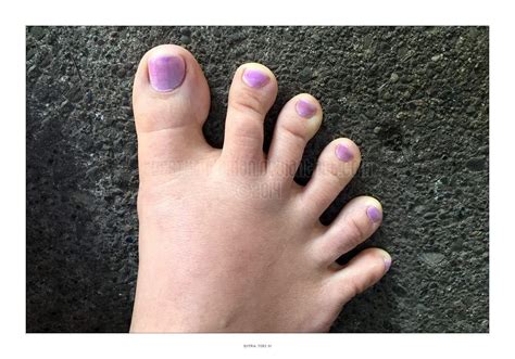 Polydactyly Marietta Foot Doctor Learn More Now