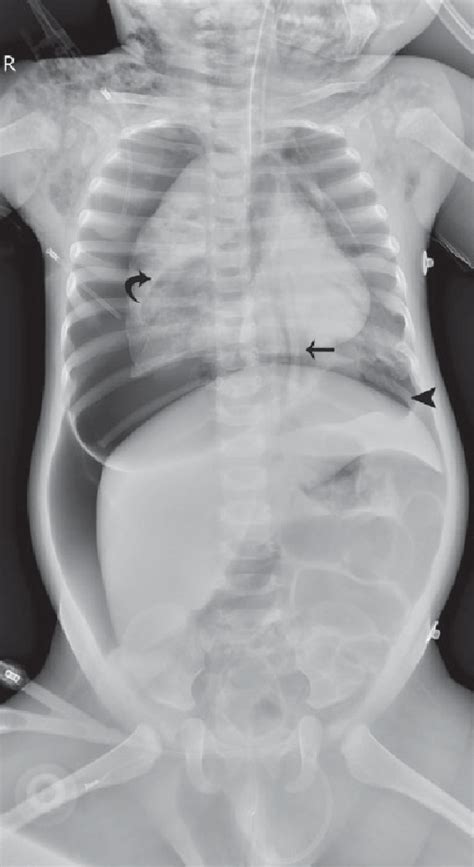 Chest Radiography Findings Showing Bilateral Pneumothorax Subcutaneous SexiezPicz Web Porn