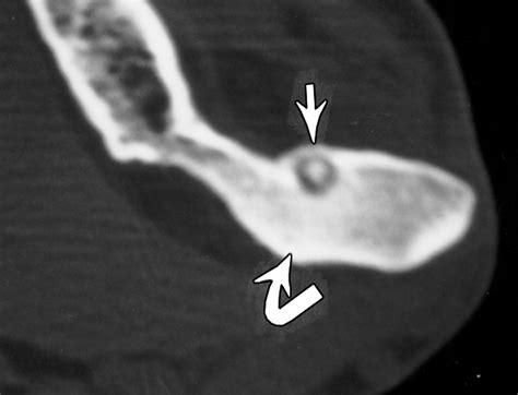 Intraarticular Osteoid Osteoma Sonographic Findings In Three Patients