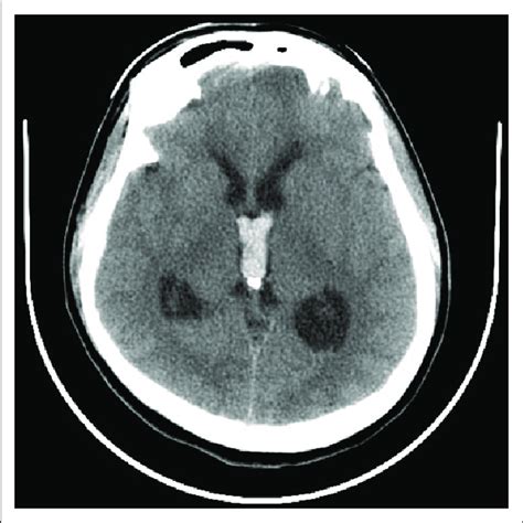 Ct Shows Intraventricular Hemorrhage With Obstructive Hydrocephalus