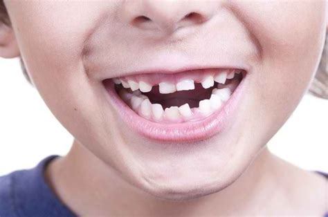 Gigi bawah biasanya tumbuh dahulu sebelum gigi atas. Merawat Kesehatan Bayi Dimulai dari Gigi Susu - Alodokter