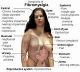 What Doctor Do You See For Fibromyalgia Images