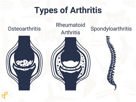 A Clinicians Guide To Arthritis Embodia