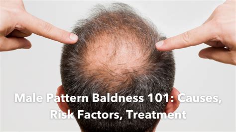 Male Pattern Baldness 101 Causes Risk Factors Treatment Homage