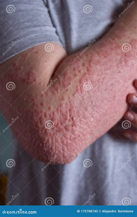Forearm View With Psoriasis Stock Image Image Of Elbow Genetic