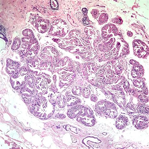 Changes In Phyllodes Tumour In Breast 100x Hande Rhistopathology