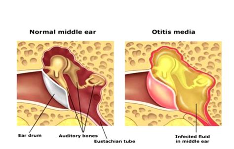 Middle Ear Infection Cure For Otitis Media