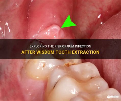Exploring The Risk Of Gum Infection After Wisdom Tooth Extraction Medshun