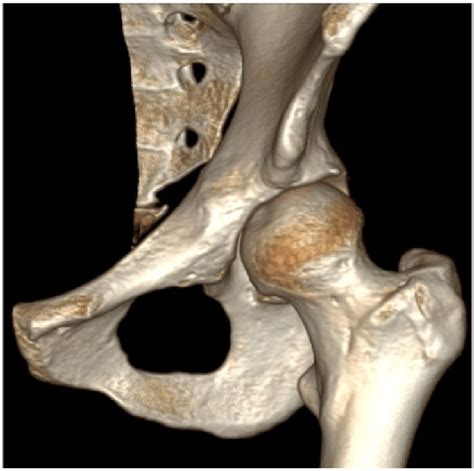 A 3d Ct Scan Demonstrating Anterior Acetabular Undercoverage In A