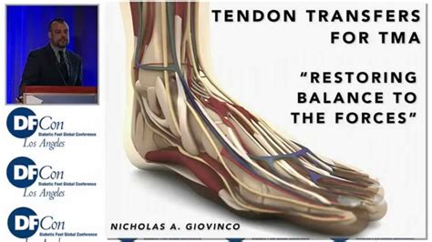 Tendon Transfer For Tma Restoring Balance To The Forces Youtube