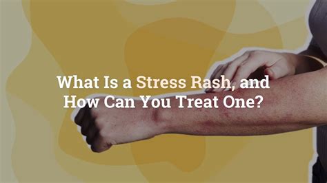 What Is A Stress Rash And How Can You Treat One
