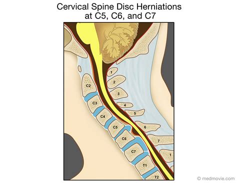 Cervical Spine Disc Herniations At C C And C Medmovie Com