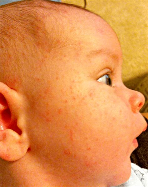 However, this is not usually the case as it's. dairy allergy in baby | HappinessYpunto!