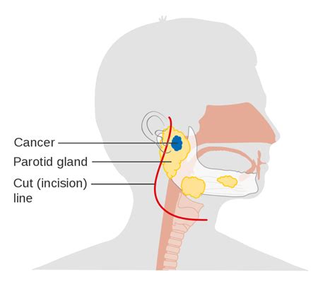 Specialist Of Parotid Surgery Dubai