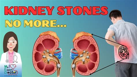 8 Simple Ways To Prevent Kidney Stones What Causes Kidney Stones