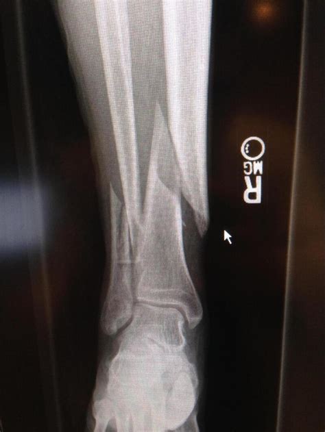 Spiral Fracture Of Fibula