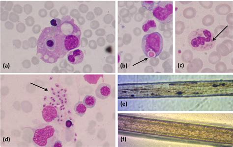 Recent Advances In The Diagnosis And Treatment Of Hemophagocytic