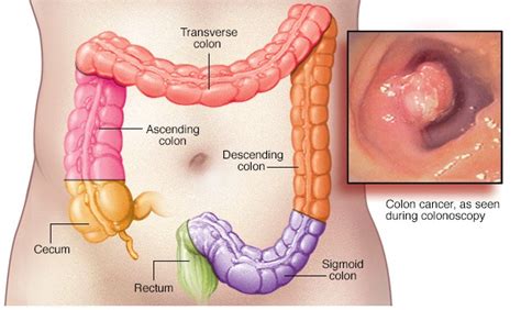 7 Early Warning Signs Of Colon Cancer Most People Miss