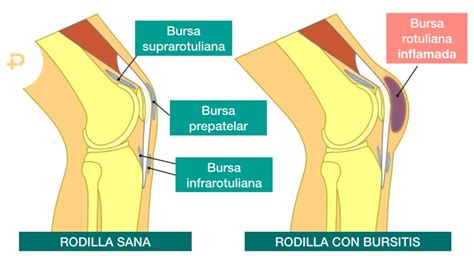 Bakterien Phobie Puppe Bursitis Rodilla Sintomas Z Gern Verachtung