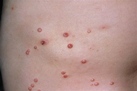 Derm Dx Clusters Of Smooth Pearly Umbilicated Papules In A Year Old Clinical Advisor