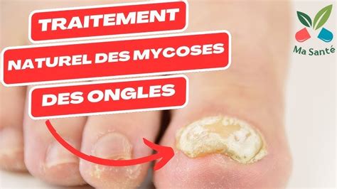 Mycose De Longle De Pied Diagnostic Symptômes Et 41 Off