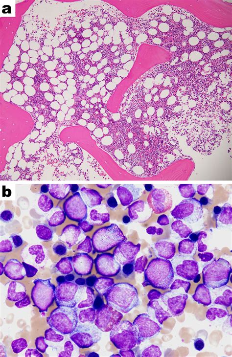 Figure2a Bone Marrow Biopsy A And Smear B A Bone Marrow Biopsy