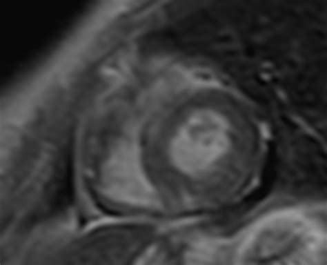 Cmr is ideally suited to answer that. Myocarditis | Image | Radiopaedia.org