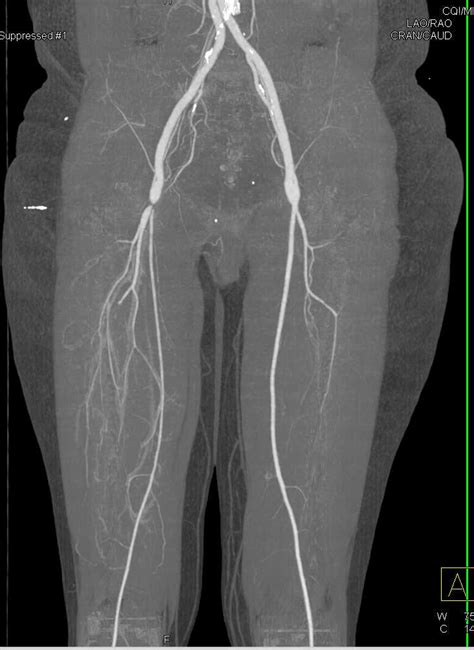 high grade stenosis  femoral artery vascular case studies ctisus ct scanning