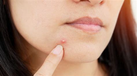 Stop Before You Pop That Pimple Heres What You Should Know Iwmbuzz