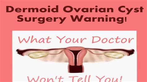 Beware From Dermoid Ovarian Cyst Best Ways To Cure Dermoid Ovarian Cyst
