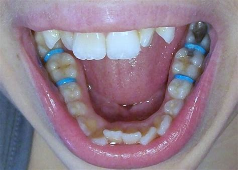 Salt water also helps to heal the sores, cuts and ulceration in your inner mouth and gums. Spacers for Braces (Teeth Separators): Uses, Pain Relief ...