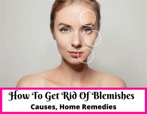 How To Get Rid Of Blemishes At Home Home Remedies Beauty And