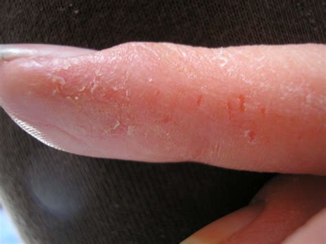 Eczema On Knuckles