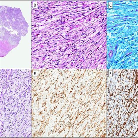 Myxoid Leiomyosarcoma Is Characterized By An Irregular Tumor Border A