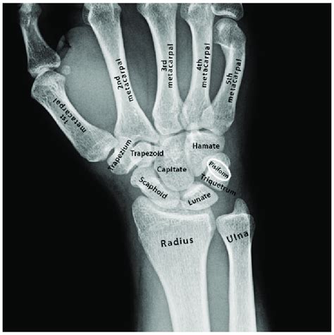 Bones Of The Human Hand And Wrist By Download