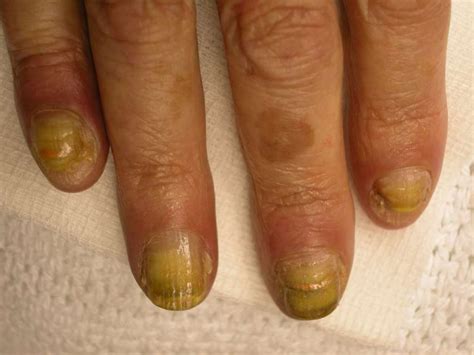 Discolored Fingernails And Toenails