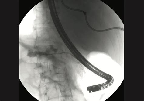 Pancreaticopleural Fistula Diagnosis And Management Of Three Cases