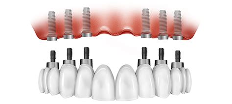 The Patients Guide To All On 6 Dental Implants 1st Choice Dental Care