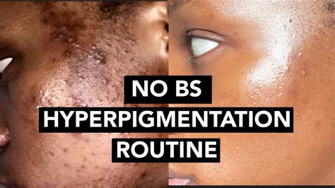 A Hyperpigmentation Routine That Works Skincare Routine Youtube
