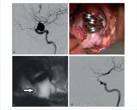 A Ccag Detected A Giant Paraclinoid Aneurysm Of The Left Ica B Clipped