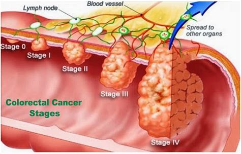 Learn the symptoms of stage iv colon cancer and which tests your doctor uses your doctor will use tests to diagnose and learn the stage of your colon cancer. Know more colorectal colon cancer- Southlake General Surgery