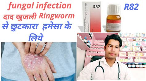 R82 German Antifungal Drop Homeopathic Medicine For Fungal Infection
