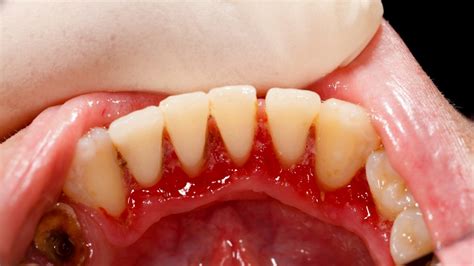 Gum Disease A Cancer Risk Factor Scottsdale Cosmetic Dentistry Excellence