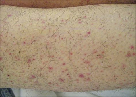 Fatigue And Lower Extremity Ecchymosis In A 36 Year Old Woman—diagnosis