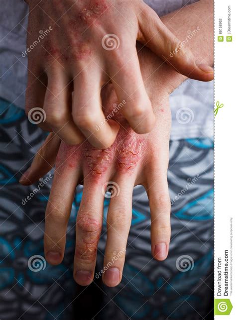 Closeup Men Itching And Scratching By Hand Psoriasis Or Eczema On The