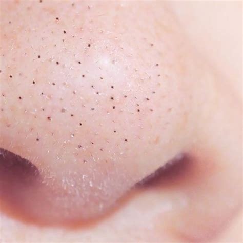 Sebaceous Filaments Vs Blackheads Whats The Difference Eminence