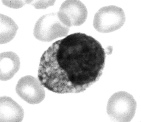 Peripheral Blood Lymphocyte Appearance In A Case Of I Cell Disease