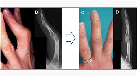 Before And After Rheumatoid Arthritis Surgery On Hands Feet