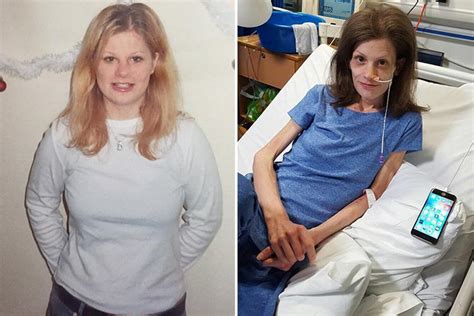Woman Weighing Just 4st Had To Convince Docs She Wasnt Anorexic But